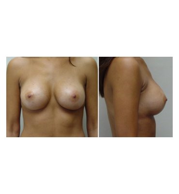 Anatomic Breast Implants After